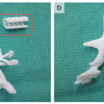 3D printed tracheal splint image