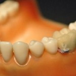 Teeth Probe