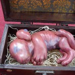 Chimera-fetus2