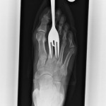 Fork X-Ray