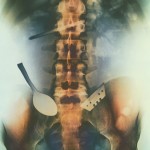 Intestine X-Ray