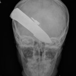 Knife X-Ray