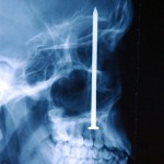 Nail Gun X-Ray Accident