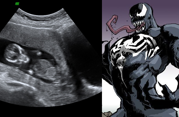 Venom Ultrasound