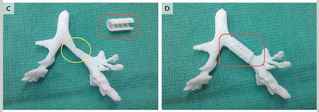 3D printed tracheal splint image